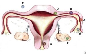 Sites and frequencies of ectopic pregnancy – most commonly in the fallopian tube, followed by the ovary, cervix, and abdomen_Medicobridge.