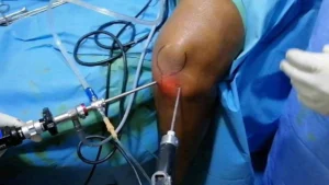 a minimally invasive surgical procedure using a small camera and instruments to diagnose and treat knee joint conditions_Medicobridge.


