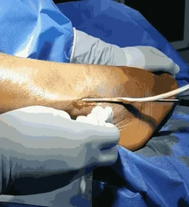 a surgical procedure where the peroneus longus tendon is carefully extracted for use in ligament reconstruction, such as ACL repair_Medicobridge.
