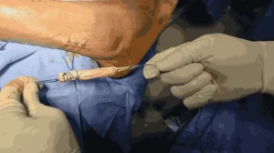 a harvested and processed tendon graft ready for use in anterior cruciate ligament (ACL) reconstruction to restore knee stability_Medicobridge.