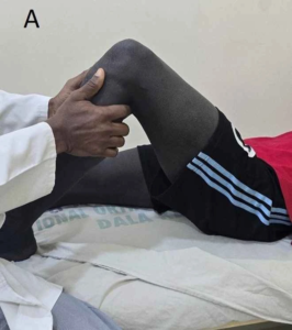  (A) Anterior Drawer Test, a physical examination technique used to assess anterior cruciate ligament (ACL) integrity by evaluating forward movement of the tibia_Medicobridge.