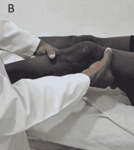 (B) Lachman Test, a diagnostic maneuver used to assess ACL integrity by evaluating the forward translation of the tibia with the knee slightly flexed_Medicobridge.