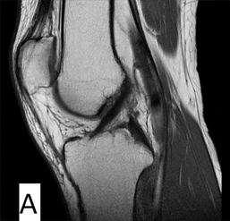 (A) Normal ACL, displaying an intact anterior cruciate ligament with proper alignment and fiber continuity_Medicobridge.
