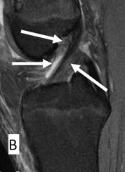 (B) Torn ACL, indicating a disrupted anterior cruciate ligament with abnormal fiber discontinuity and possible swelling_Medicobridge.