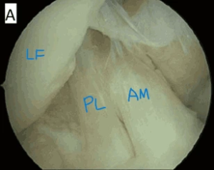 (A) Normal ACL, showing LF (Lateral Femoral Condyle), PL (Posterolateral Bundle), and AM (Anteromedial Bundle) with intact structure and function_Medicobridge.