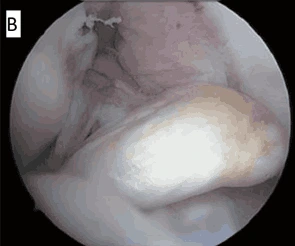  (B) Ruptured ACL, showing disrupted ligament fibers with loss of normal continuity, affecting knee stability and function_Medicobridge.