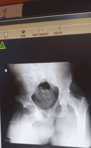 Pelvic Plain Radiograph – an X-ray imaging technique used to assess the pelvis, hip joints, and surrounding structures for fractures, abnormalities, or medical conditions_Medicobridge.