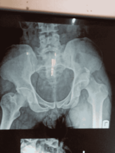 Pelvic Plain Radiograph – an X-ray scan used to evaluate the pelvis, hip joints, and surrounding structures for fractures, deformities, or medical conditions_Medicobridge.