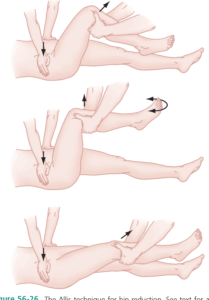 Allis Method for Hip Reduction – a manual technique for reducing a hip dislocation by applying upward traction while stabilizing the pelvis to guide the femoral head back into the acetabulum_Medicobridge.