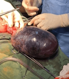 a large blood-filled ovarian cyst resulting from bleeding into a follicular or corpus luteum cyst, potentially causing pain and complications_Medicobridge.


