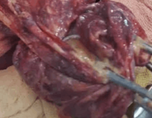 a medical condition where an ovarian cyst or the ovary itself bursts, leading to internal bleeding, severe pain, and potential complications requiring urgent medical attention_Medicobridge.