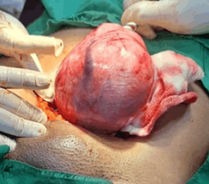 a benign ovarian tumor containing tissues like hair, skin, and fat, typically occurring on the left ovary and potentially causing pain or complications_Medicobridge.