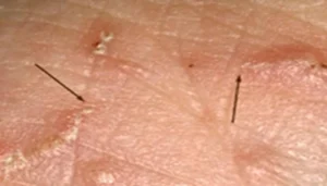 A sketch and picture showing scabies mite burrows in the stratum corneum of the skin