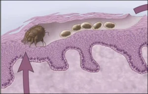 A sketch and picture showing scabies mite burrows in the stratum corneum of the skin