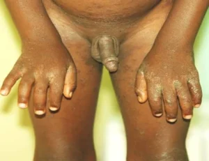 Showing distribution of the scabietic rashes in the child