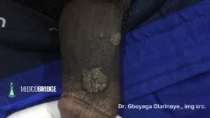 Genital herpes in a black skin