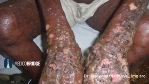 Bullous pemphigoid on the upper limb