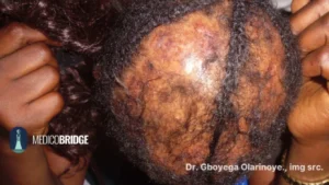 Central alopecia 