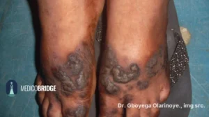 Contact dermatitis on the feet