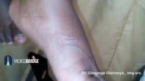 Cutaneous larva migrans on the foot of an African skin