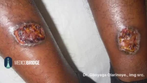 Leshmaniasis on the limbs of a black skin