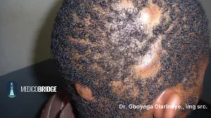 Dissecting cellulitis, also known as perifolliculitis capitis abscedens et suffodiens, is a chronic inflammatory scalp condition most seen in men of African descent.