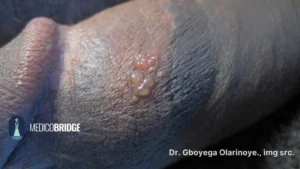 Genital herpes in a black skin