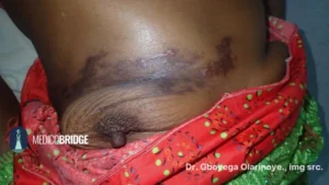 Shingles under the breast in an African woman