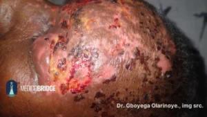 Shingles on a black skin