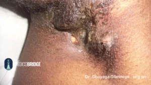 Indurating boils on a dark skin