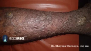 Black skin with Kaposi sarcoma
