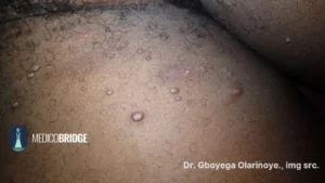 Brown skin with molluscum contagiosum