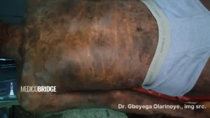 Mycosis fungoides, the most common form of cutaneous T-cell lymphoma, may present atypically in African skin as hypopigmented patches