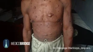 Neurofibromatosis type 1 (NF1) is a genetic disorder characterized by multiple neurofibromas