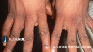 Scabies on the fingers of an African