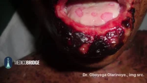 Steven Johnson in an African patient