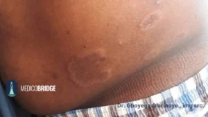 Ringworm on the left chin of a brown skinned person