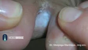 Athlete foot in dark skins 