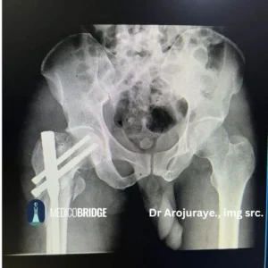  Post op plan radiograph who had CRIF with PFN on account of reverse oblique.
