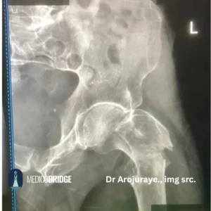 Pertrochanter fracture Picture
