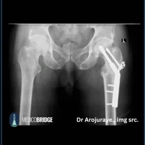Pertrochanteric fracture treated with DHS Picture