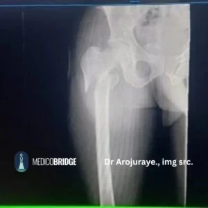 Plain radiograph: Thigh x-ray.  Anteroposterior pelvis and lateral hip X-rays. Full-length femur X-ray to exclude shaft extension. The whole extent of the thigh must be visible. 