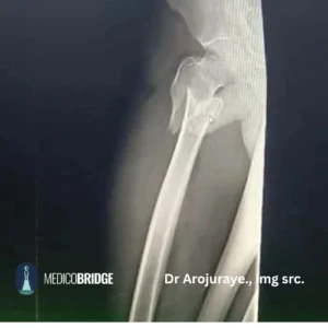 Thigh x-ray.  Anteroposterior pelvis and lateral hip X-rays. Full-length femur X-ray to exclude shaft extension. The whole extent of the thigh must be visible. 