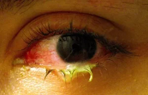 Bacterial conjunctivitis. Picture source: Bhamra J, Sylvestre-Bouchard A. Management and Treatment of Red Eyes in Primary Care.
