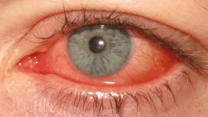Picture source: Bhamra J, Sylvestre-Bouchard A. Management and Treatment of Red Eyes in Primary Care.
