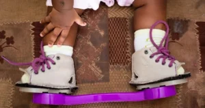 Photo credit: MiracleFeet. A child wearing the MiracleFeet FABs. There are also the Iowa braces, Steinbeek, etc.