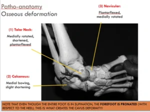 Patho-anatomy of Clubfoot